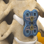 Anterior Cervical Discectomy and Fusion