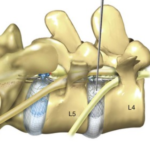 Endoscopic Lumbar Discectomy