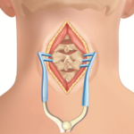 Posterior Cervical Decompression and Fusion