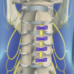 Posterior Cervical Laminoplasty